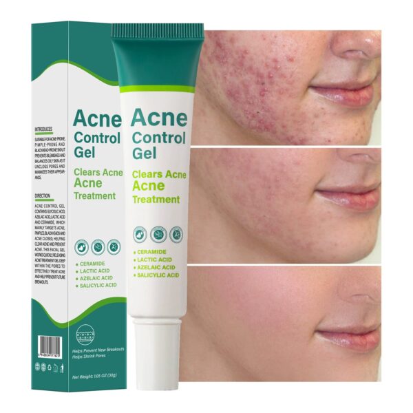 Acne Control Gel