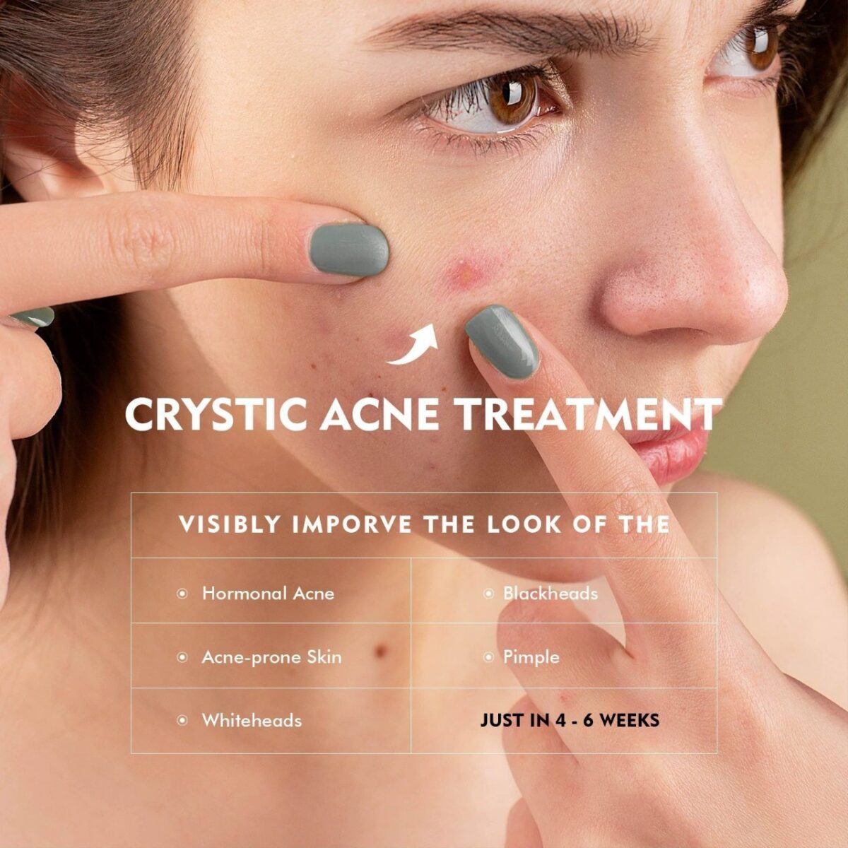 Acne Control Gel - Image 3