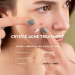Acne Control Gel - Image 3